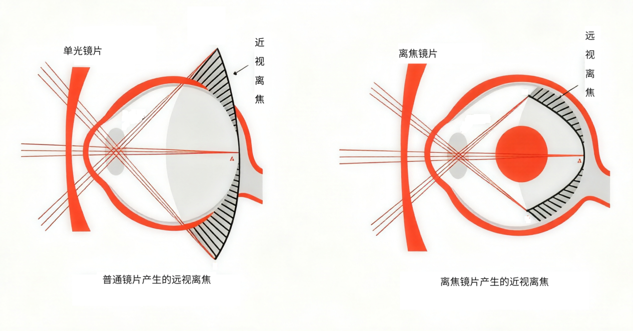 如果视网膜周边成像落在后面(远视离焦),大脑就会发出信号,让眼球继续拉长,眼轴变长,近视度数也就跟着涨上去。这也是有些孩子戴了离焦镜,效果却不理想的关键原因——每个孩子眼睛的周边“地形”,天生就不一样。 配图3